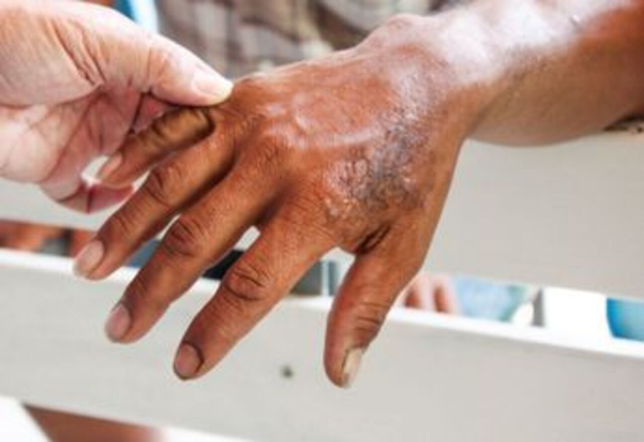 Día Mundial de la Lepra: Bolivia reitera su compromiso en la lucha contra la enfermedad