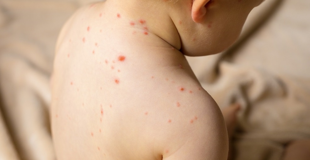 Reportan ocho casos de varicela en una unidad educativa de El Alto