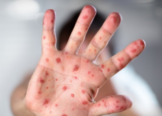 Unfpa alerta sobre riesgo de expansión del sarampión, un paciente puede contagiar a 18