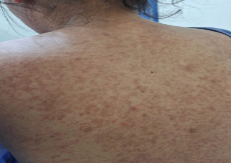 Sedes Santa Cruz declara alerta roja sanitaria por brote de sarampión