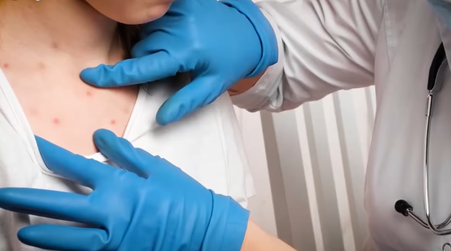 Se elevan a 14 los casos de sarampión y hay otros 15 sospechosos