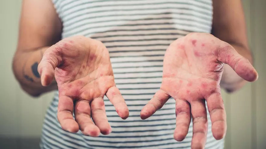 Suman 50 los casos confirmados de sarampión en Bolivia, el mayor número está en Santa Cruz