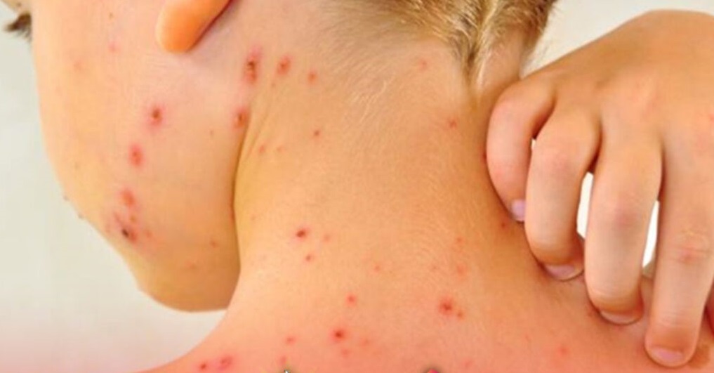 Declaran emergencia sanitaria nacional por casos de sarampión