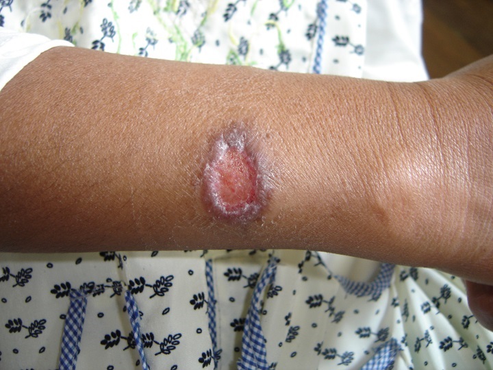 Bolivia actualiza protocolos para diagnóstico y tratamiento gratuito de la leishmaniasis