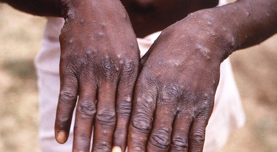 Viruela símica: Trasladan a una embarazada y a un paciente con complicaciones a hospitales de atención especializada