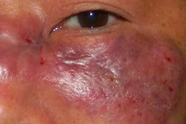 Salud pide a la población no alarmarse por presunto caso de hongo negro porque no representa peligro